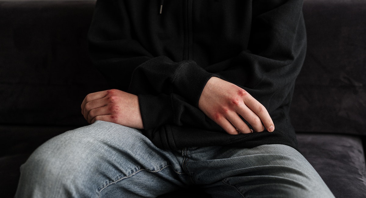 Three way Foley Catheter and Bladder Washout